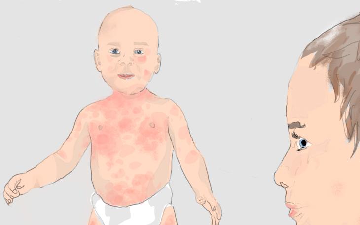 Waschmittelallergie Allergische Reaktion Haut Waschmittel www.docset.de