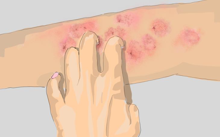 Latexallergie Anzeichen