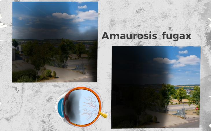 Amaurosis fugax - Plötzliche Blindheit