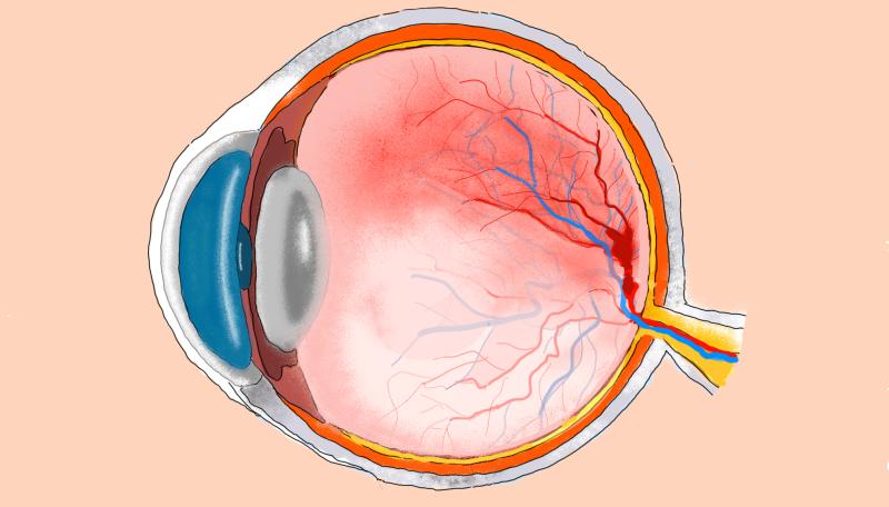 Arterienverschluss des Auges