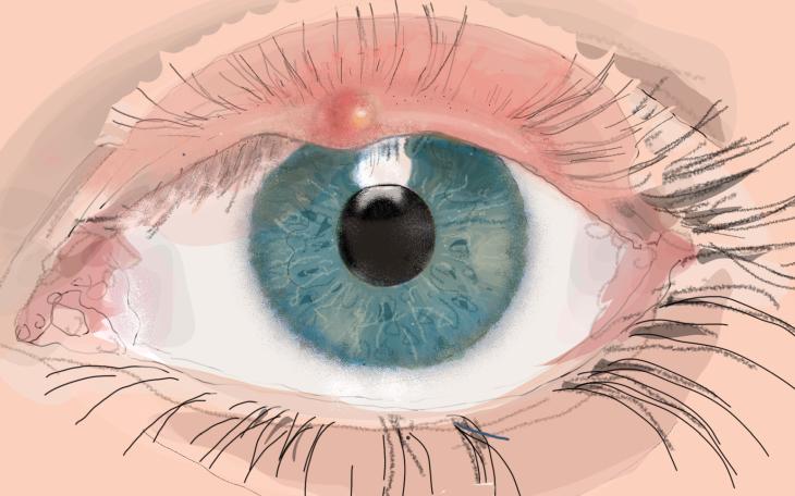 Augenlidentzündung Ursachen