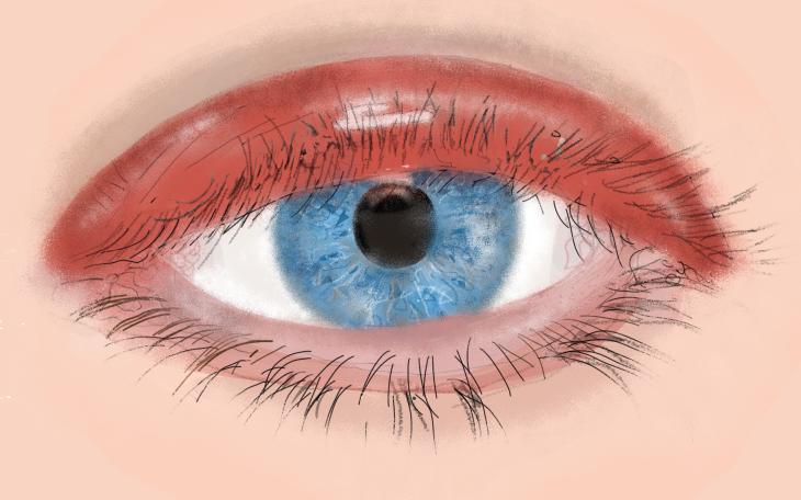 Augenlidentzündung