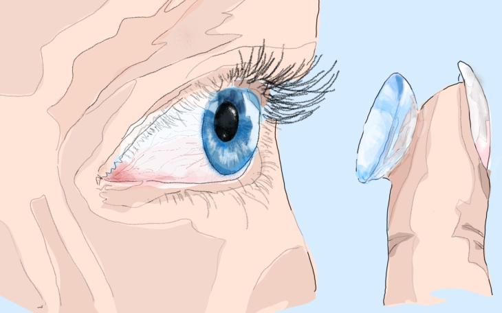 Hornhautentzündung durch Kontaklinsen