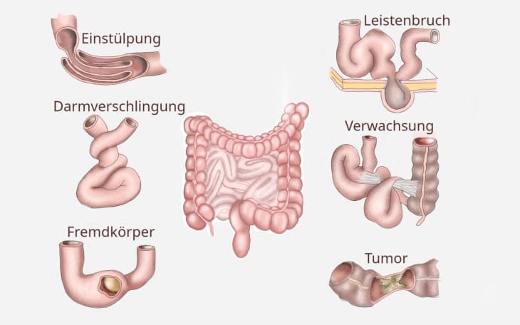 Darmverschluss