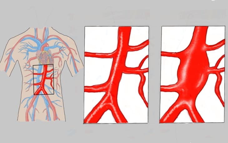 Mesenterial-Arterien-Verschluss