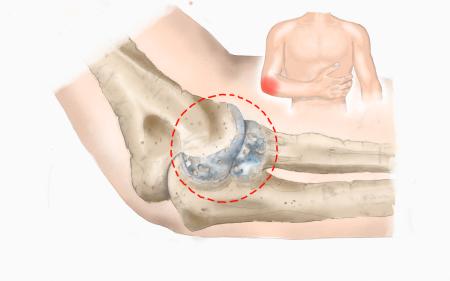 Ellenbogenarthrose Bild erkrankt