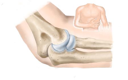 Ellenbogenarthrose Bild gesund