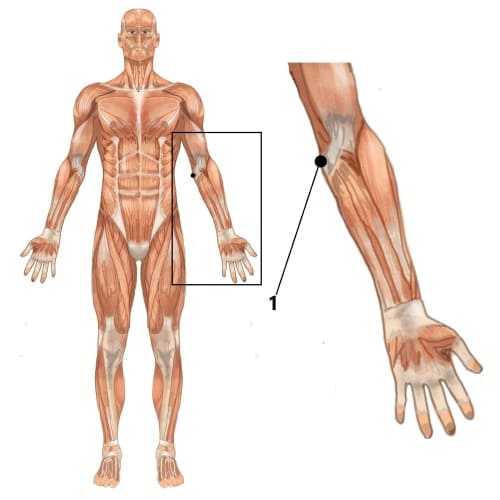 Lokalisation Golferellenbogen