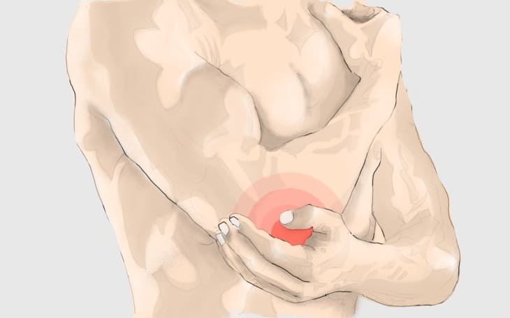 Radiusköpfchenfraktur