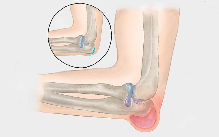 Bursitis olecrani Bursitis olecrani