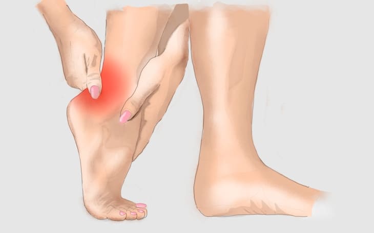 Achillessehnenentzündung Symptome