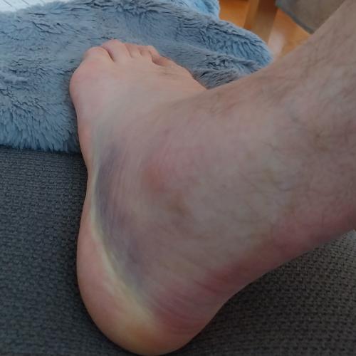 Bild eines Users zum Thema Bänderriss im Sprunggelenk