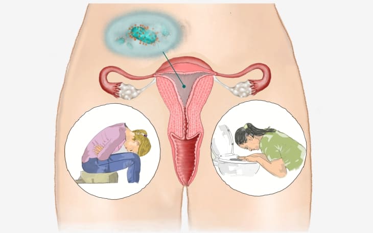 Gebärmutterentzündung (Endometritis) Gebärmutterentzündung (Endometritis)