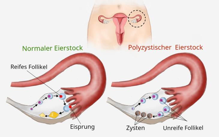polyzystische Ovarialsyndrom