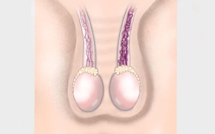 Krampfader am Hoden