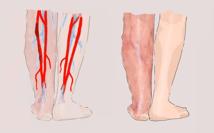 Tiefe Venenthrombose Tiefe Venenthrombose