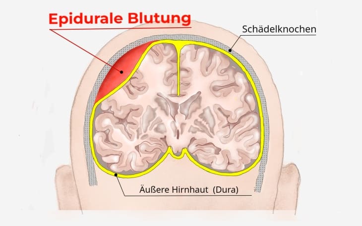 Epiduralblutung
