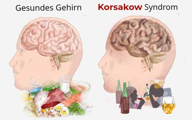 Korsakow-Syndrom