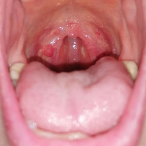 Bild eines Users zum Thema Seitenstrangangina