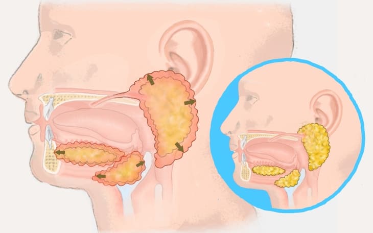 Speicheldrüsenentzündung