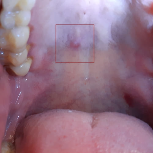 Bild eines Users zum Thema Speicheldrüsenentzündung