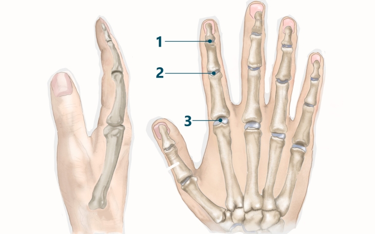 Lokalisation Abriss Strecksehne Finger