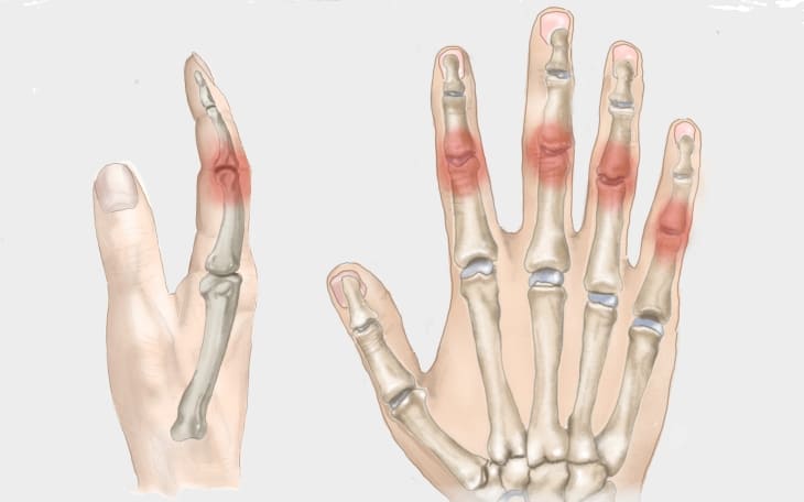 Bouchard-Arthrose Bouchard-Arthrose