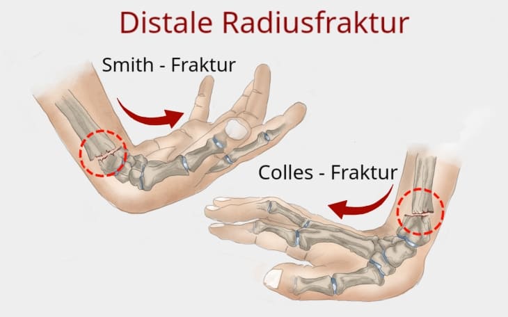 distale Radiusfraktur distale Radiusfraktur