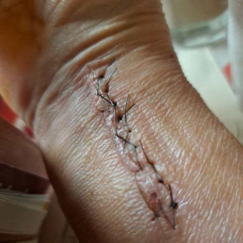 Bild eines Users zum Thema Distale Radiusfraktur