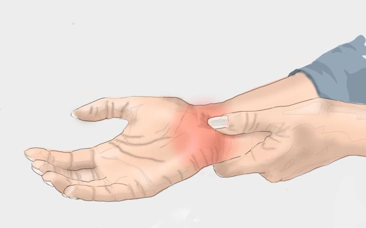 Entzündung der Hand Entzündung der Hand