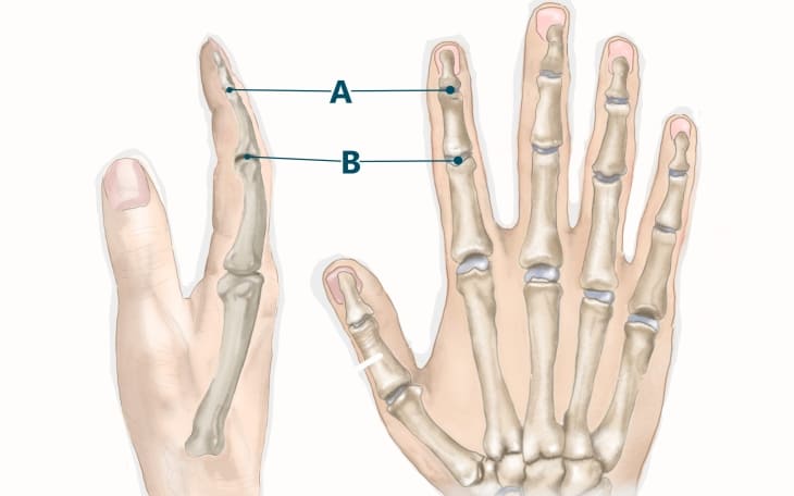 Lokalisation Fingerarthrose