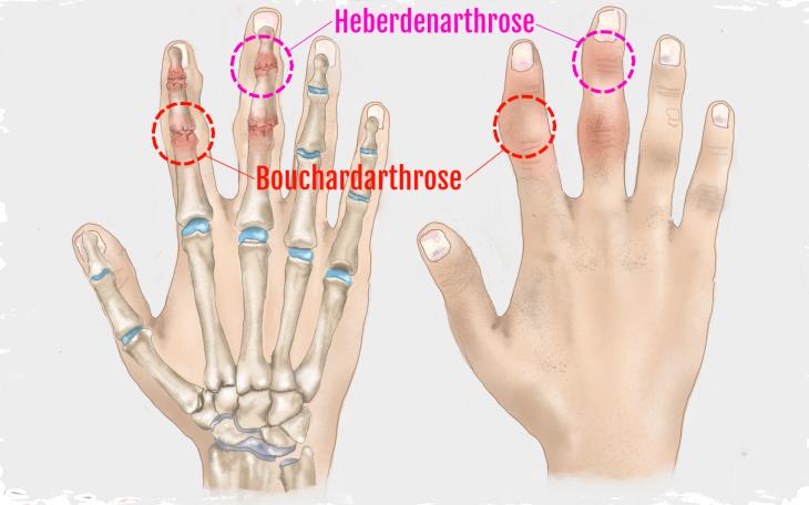 Schmerzen im Fingergelenk aufgrund einer Fingerarthrose