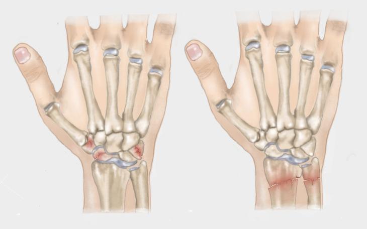 Handgelenk gebrochen