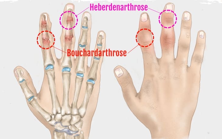 Heberden-Arthrose Heberden-Arthrose