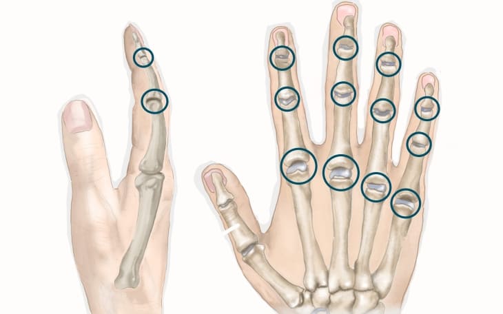 Lokalisation Kapselriss Finger