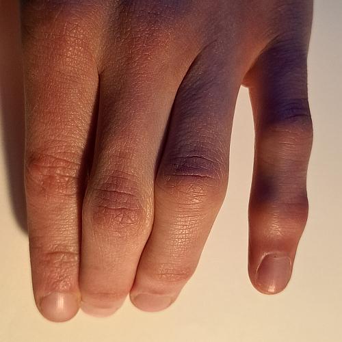 Bild eines Users zum Thema Kapselriss Finger