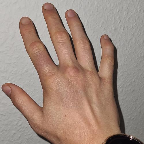 Bild eines Users zum Thema Kapselriss Finger