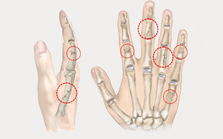 Finger gebrochen Finger gebrochen