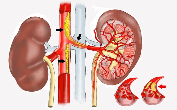 Nierenarterienstenose