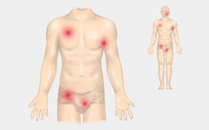 Lokalisation Abszess