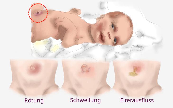 Bauchnabelentzündung