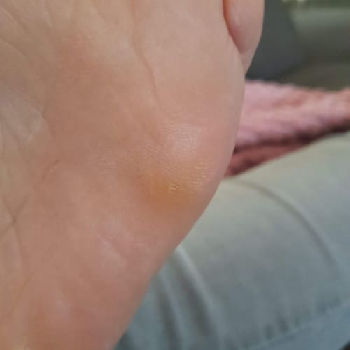 Bild eines Users zum Thema Hühnerauge