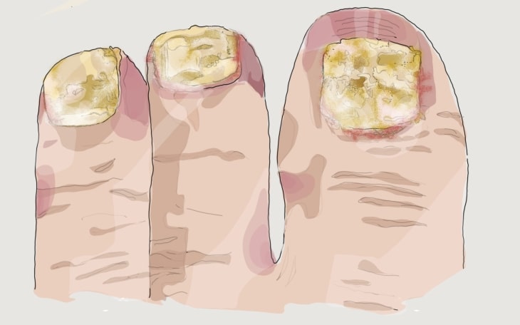 Schmerzen im großen Zeh - Nagelpilz