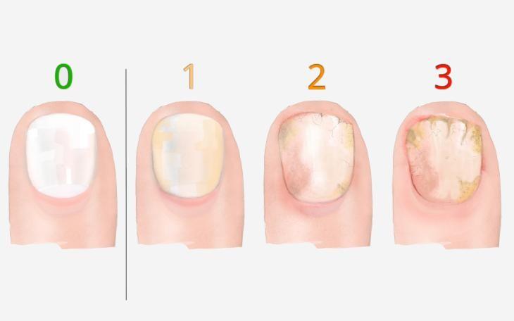 Nagelpilz Stadien