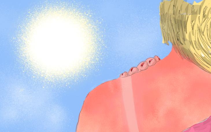 Hautausschlag ohne Juckreiz wegen Sonnenallergie