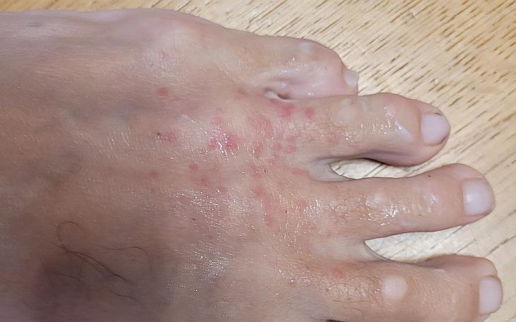 Juckende Bläschen Dyshidrotisches Ekzem Fuß