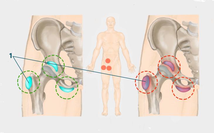 Bursitis trochanterica Bursitis trochanterica