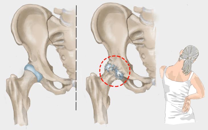 Hüftarthrose