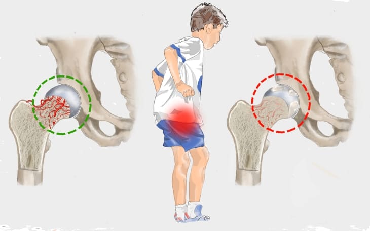 Morbus Perthes