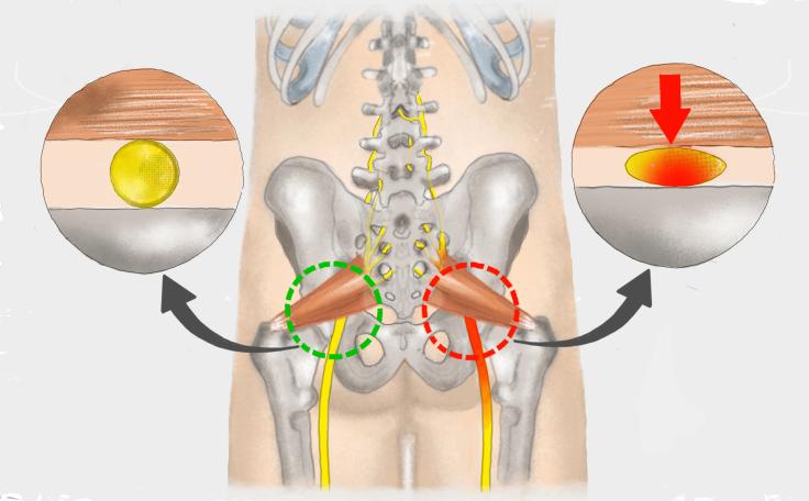 Piriformis-Syndrom